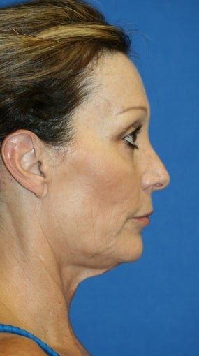 Facelift with Extended Necklift and Upper Blepharoplasty