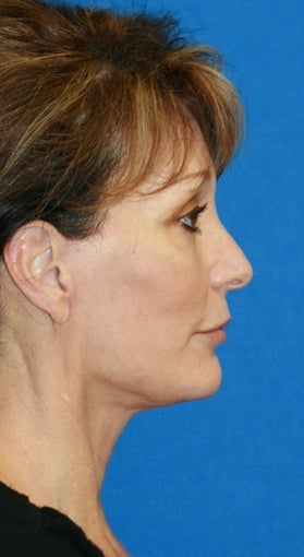 Facelift with Extended Necklift and Upper Blepharoplasty