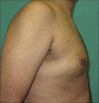 29 Year Old Male Treated for Gynecomastia with Smart Lipo Triplex