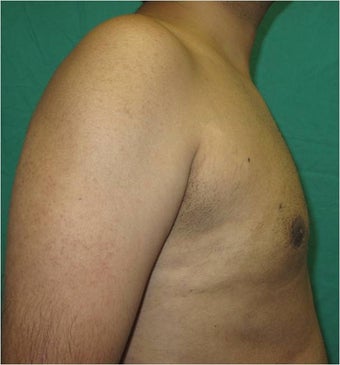 29 Year Old Male Treated for Gynecomastia with Smart Lipo Triplex