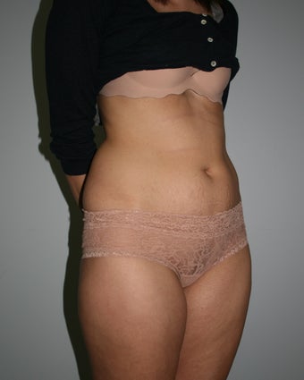 Mini-Abdominoplasty