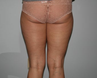 Liposuction of the Hips and Thighs
