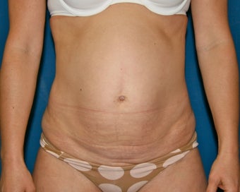 Liposuction of the Back and Abdomen