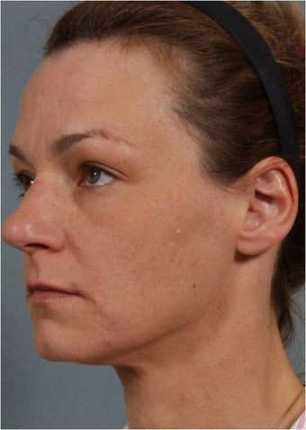 41 Year Old Female Treated for sun damage, wrinkles, and acne scars