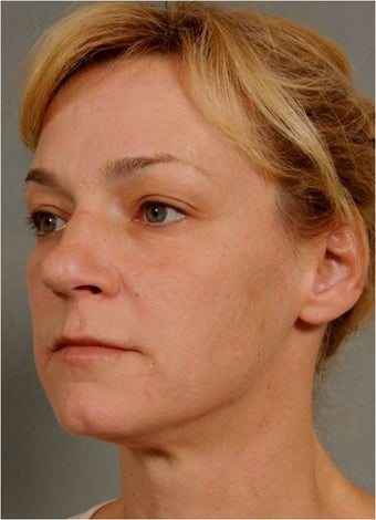 41 Year Old Female Treated for sun damage, wrinkles, and acne scars