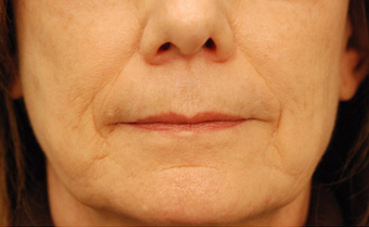 Restylane injectable filler