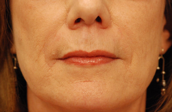 Restylane injectable filler