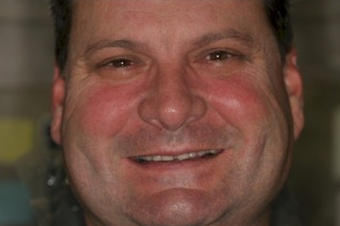 Full mouth dental reconstruction