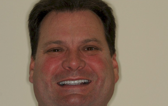 Full mouth dental reconstruction