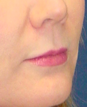 Lip Augmentation with lip lift
