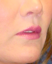 Lip Augmentation with lip lift