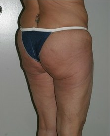 Thigh and Buttock Lift