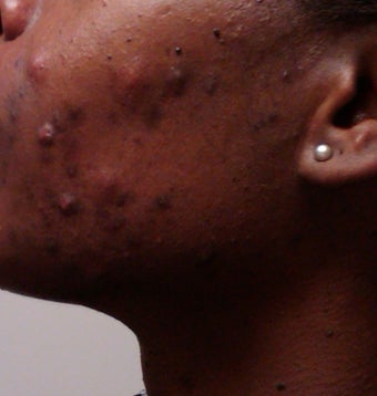 Accutane
