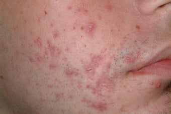 Acne treatment with Accutane