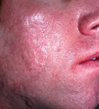 Acne Scarring