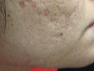 Severe, Deep Acne Scars with Punch Elevation