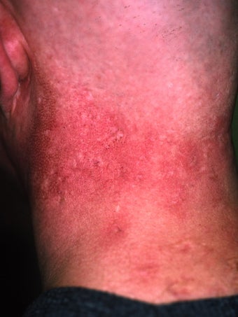Acne Scarring