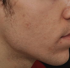 Acne Scarring