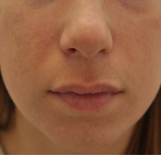 Acne Scarring