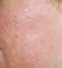 Acne Scar Vitalizer Treatment