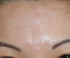 Before and After Acne Scar Treatment with Subcision and cO2 Laser Resurfacing 