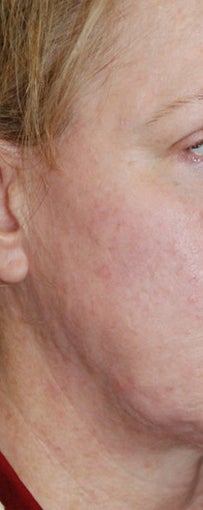 Before and After Multiple Excisions, Fat Grafting and Co2 Laser Active Fx Resurfacing Acne Scar Treatment
