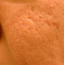 Before and After Subcision and TCA CROSS (Chemical Reconstruction of Skin Scars) Method of the Right Cheek
