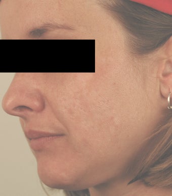 Laser Acne Scar Removal