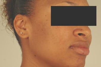 Laser Acne Scar Removal
