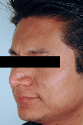 Brown Acne Scars in Santa Ana, CA.  Remove Acne Scars with Lasers.