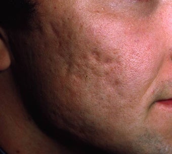 Acne Scarring
