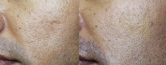 Acne Scar Treated with Sculptra