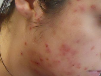 Severe Acne - Photodynamic Treatment