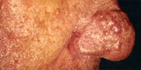 Severe Acne Rosacea