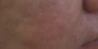 Severe Acne Rosacea Treatment