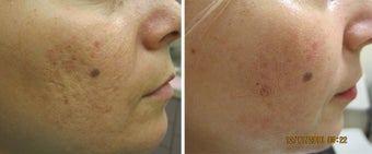 Fractional Resurfacing Acne Scars