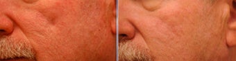 Silicone for Acne Scarring