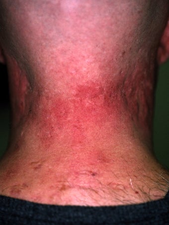 Acne Scarring