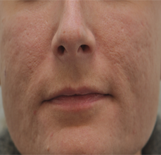 Acne Scarring
