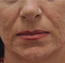 Acne Scarring