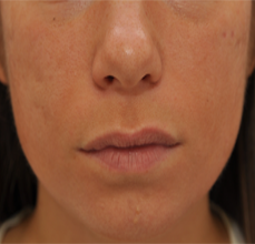 Acne Scarring