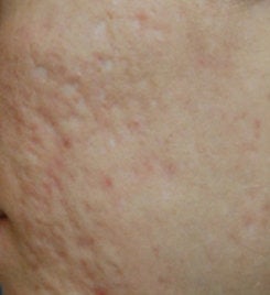 Acne Scar Vitalizer Treatment