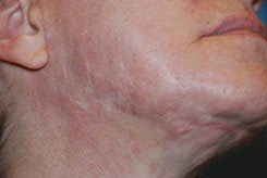 Acne Scar Treatment with Surgical Excisions and Geometric Line Closures.