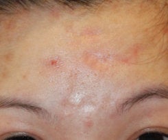 Before and After Acne Scar Treatment with Subcision and cO2 Laser Resurfacing 