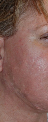 Before and After Multiple Excisions, Fat Grafting and Co2 Laser Active Fx Resurfacing Acne Scar Treatment