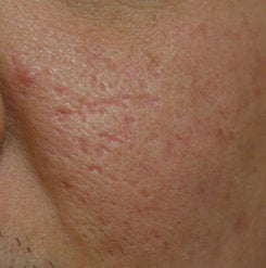 Before and After Subcision and TCA CROSS (Chemical Reconstruction of Skin Scars) Method of the Right Cheek