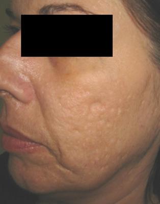 Laser Acne Scar Removal