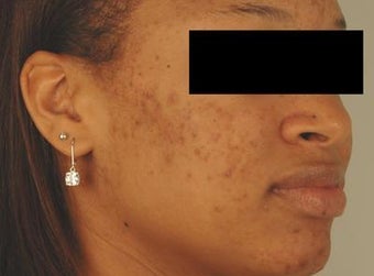 Laser Acne Scar Removal