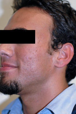 Laser Acne Scar Removal