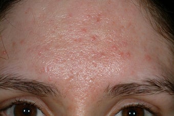 Acne scars